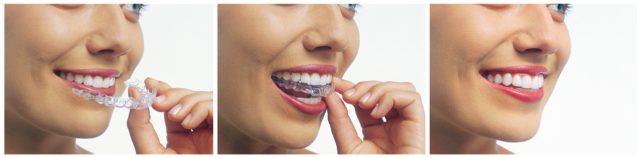 Invisalign® Clear Aligner Therapy